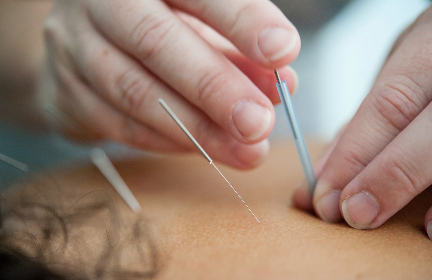 Acupuncture: A Comprehensive Guide to What You Need To Know - Benefits, Safety, and More
